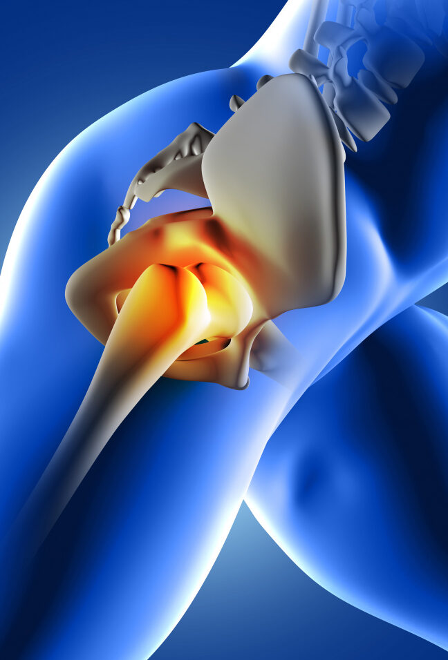 Arthrose des Hüftgelenkes – Coxarthrose - Dr. med. Ahmet Ercan